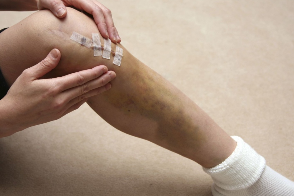 Confira alguns cuidados essenciais no pós-operatório do ligamento cruzado anterior.