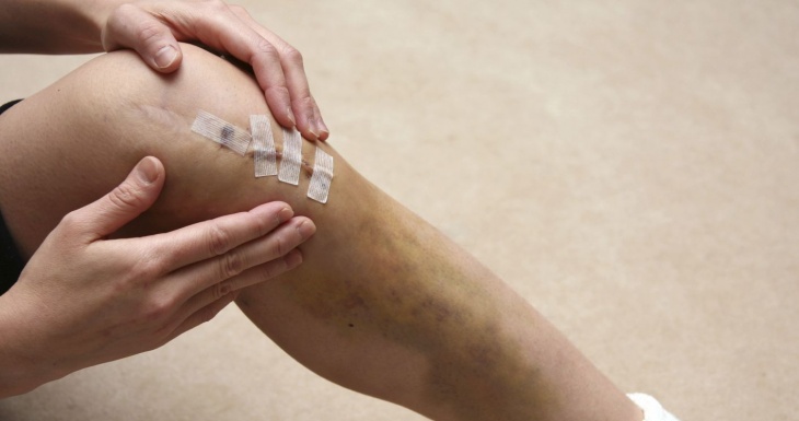 Confira alguns cuidados essenciais no pós-operatório do ligamento cruzado anterior.